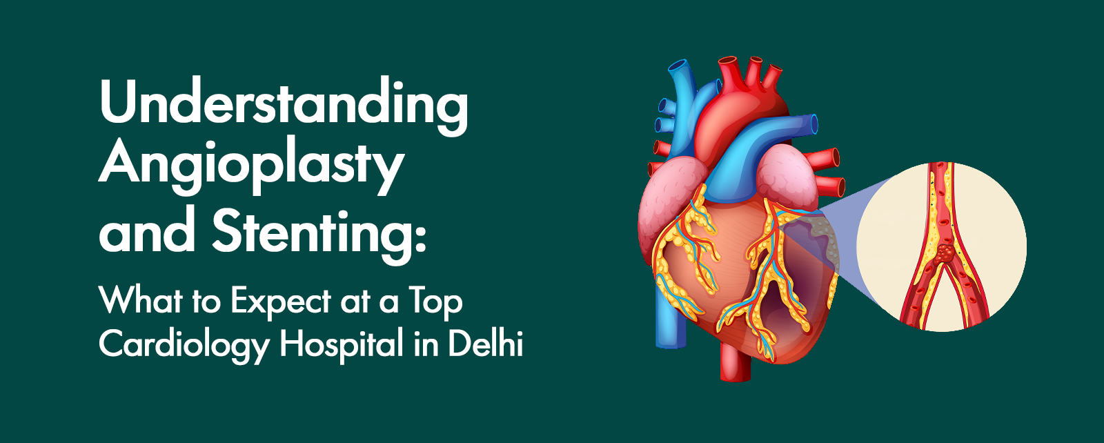 Understanding Angioplasty and Stenting: What to Expect at a Top Cardiology Hospital in Delhi
