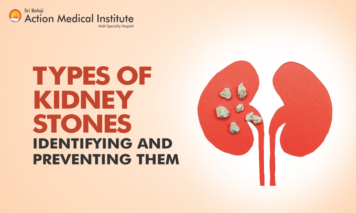 Types of Kidney Stones: Identifying and Preventing Them
