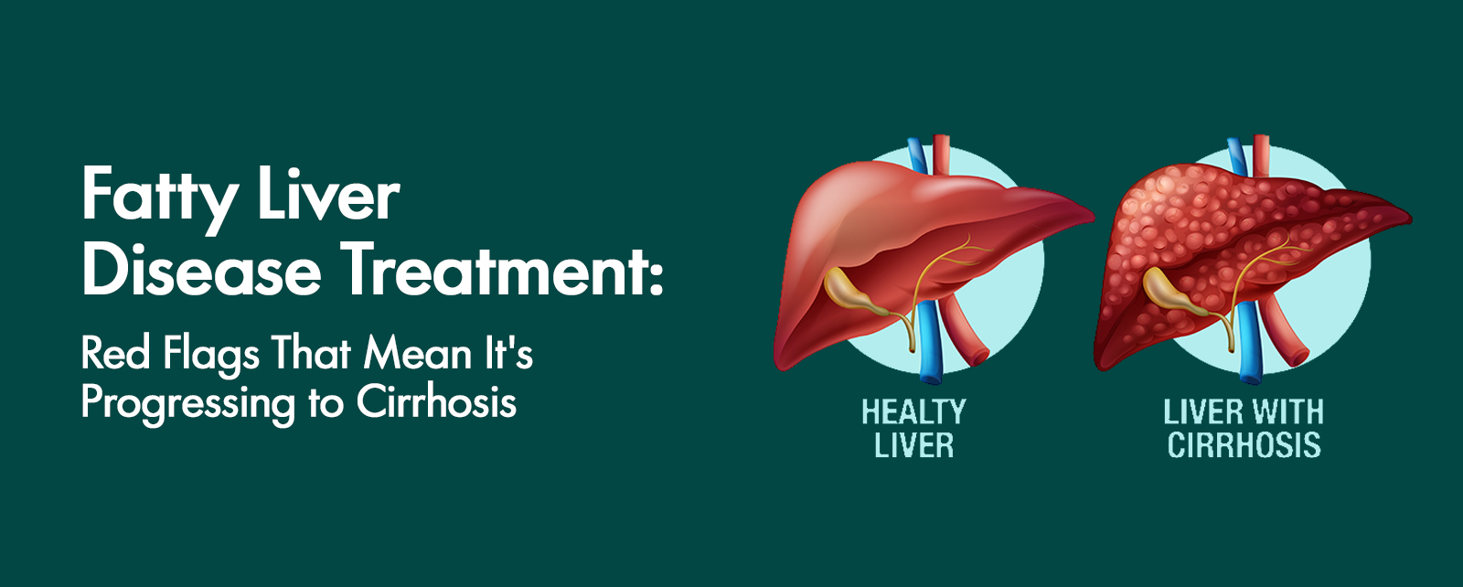 Fatty Liver Disease Treatment: Red Flags That Mean It's Progressing to Cirrhosis